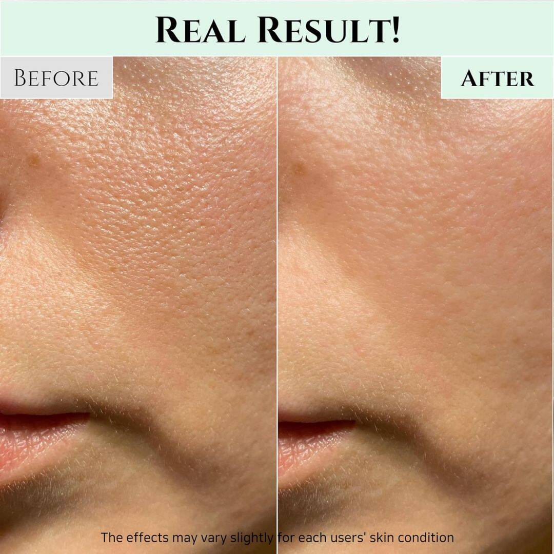 Before and after comparison of skin texture on a person's face.